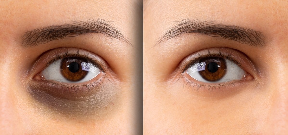 pigmentation